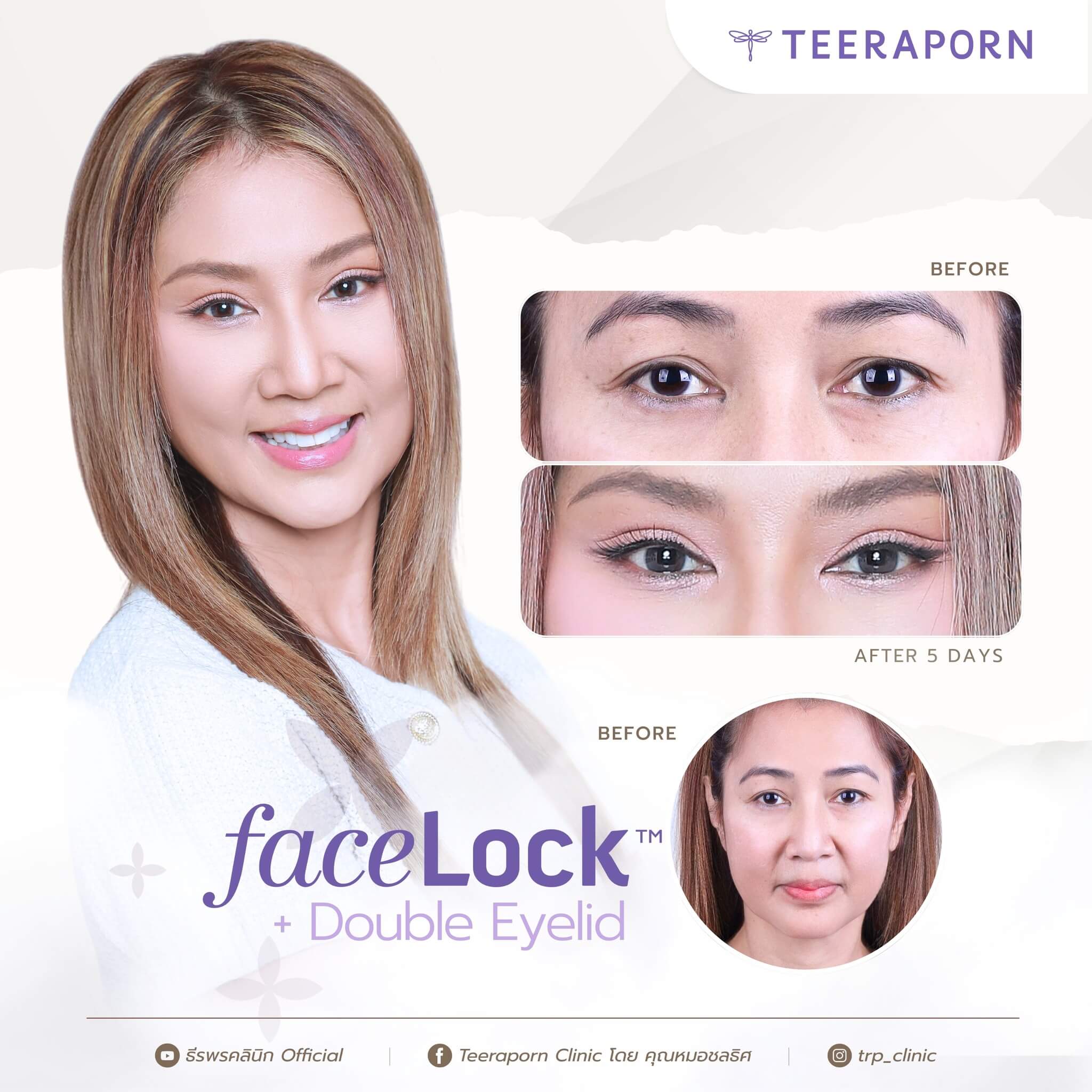 ธีรพรคลินิก ตาสองชั้น ราคา