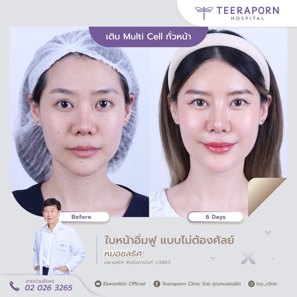 เติมไขมันหน้าเด็ก