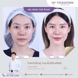 เติมไขมันหน้าเด็ก