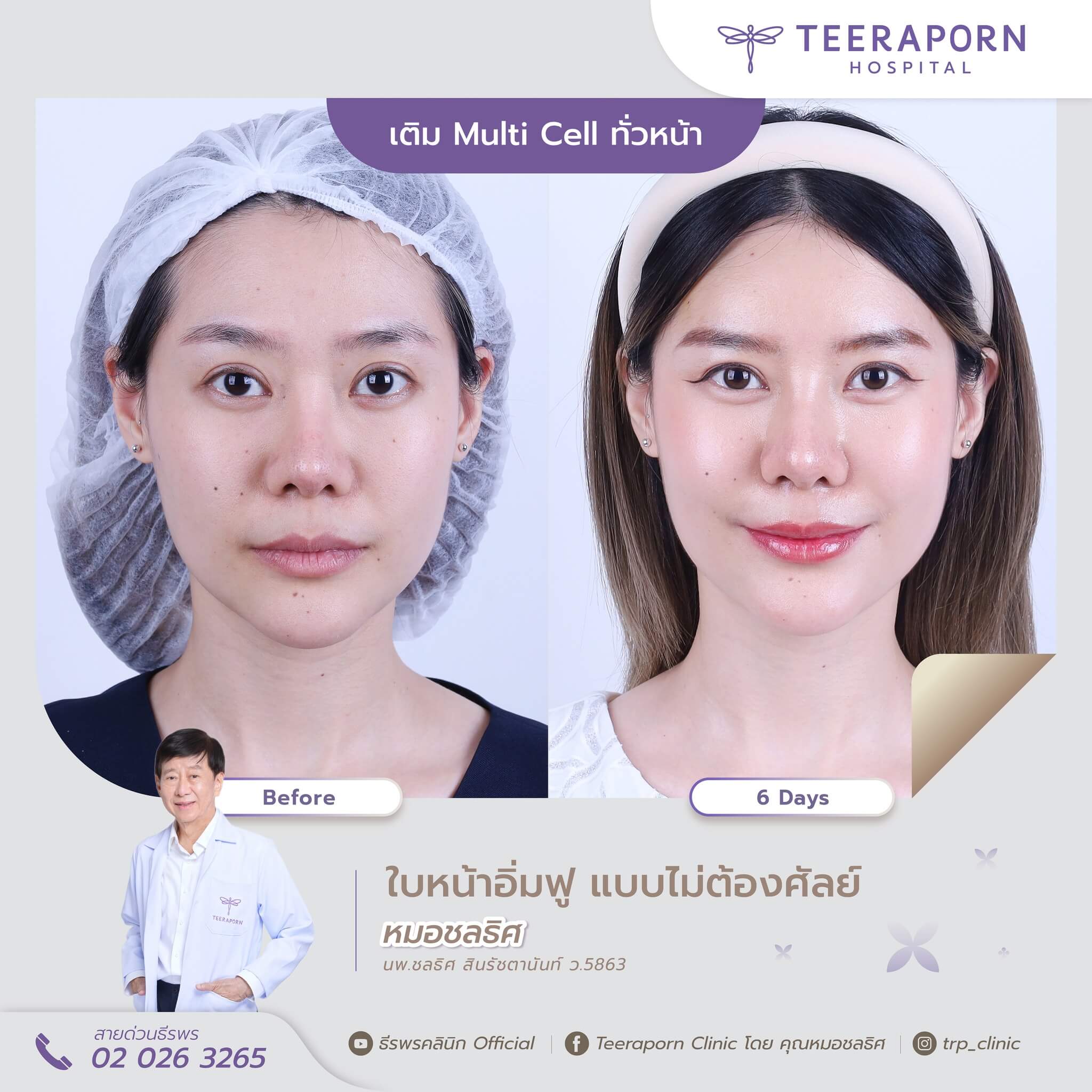 เติมไขมันหน้าเด็ก