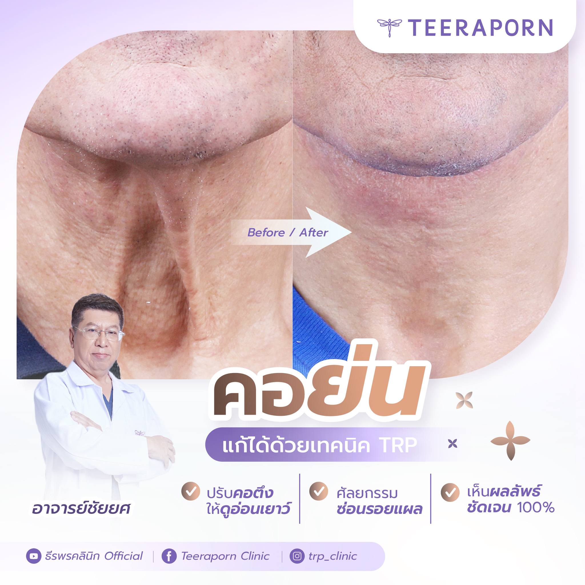 คอเหี่ยว