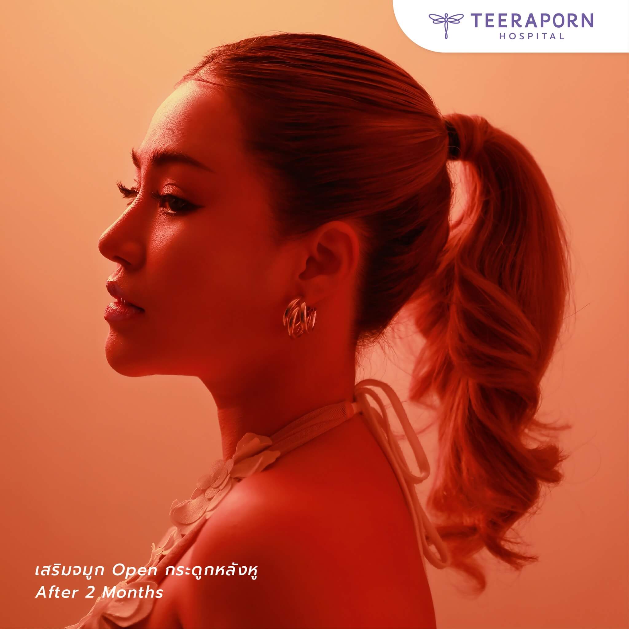 เสริมจมูก slc pantip