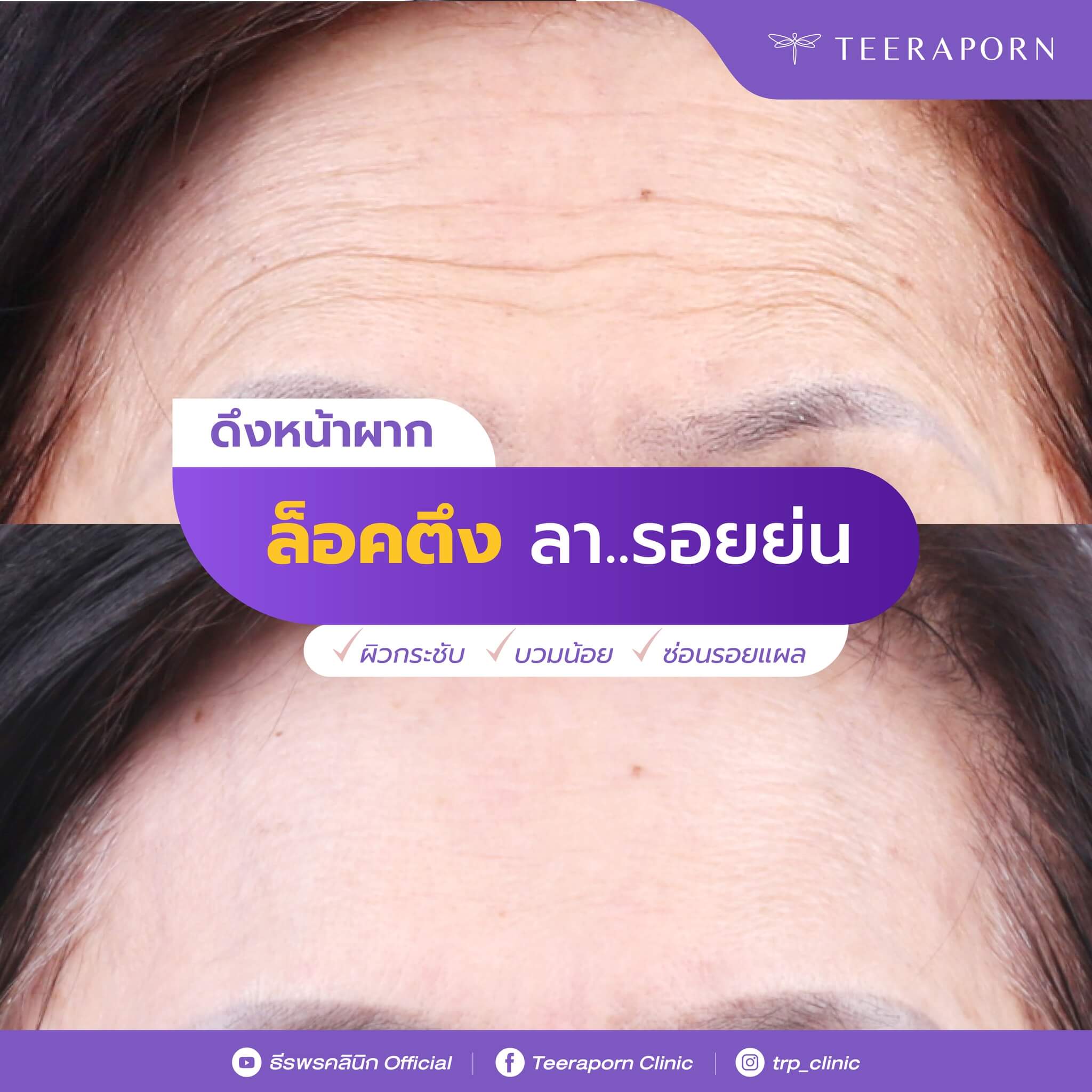 ดึงหน้าผาก