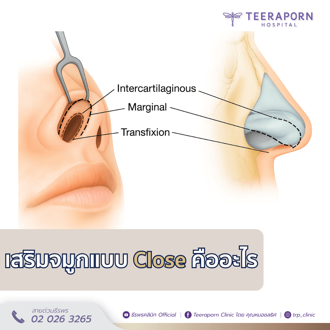 เสริมจมูกแบบ close