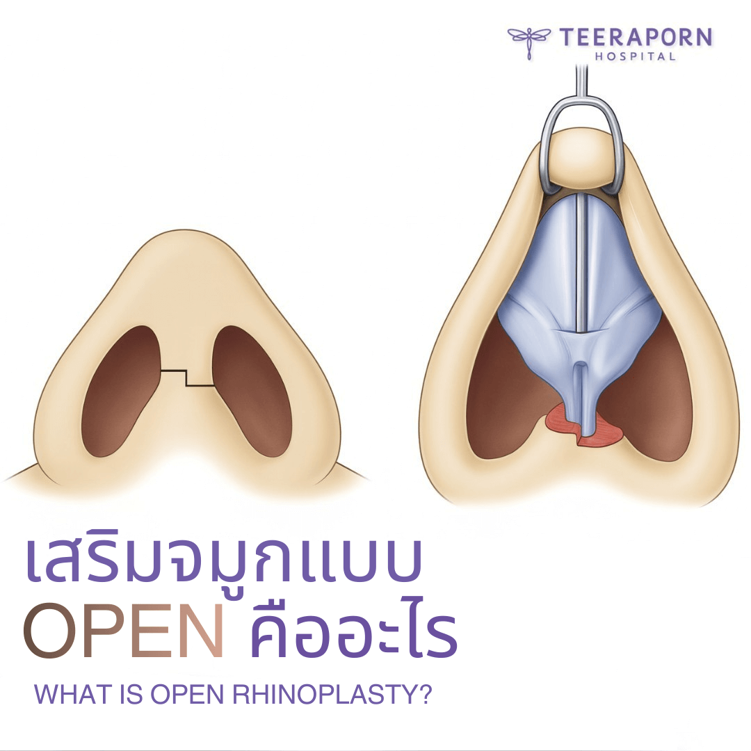 เสริมจมูกแบบโอเพ่น