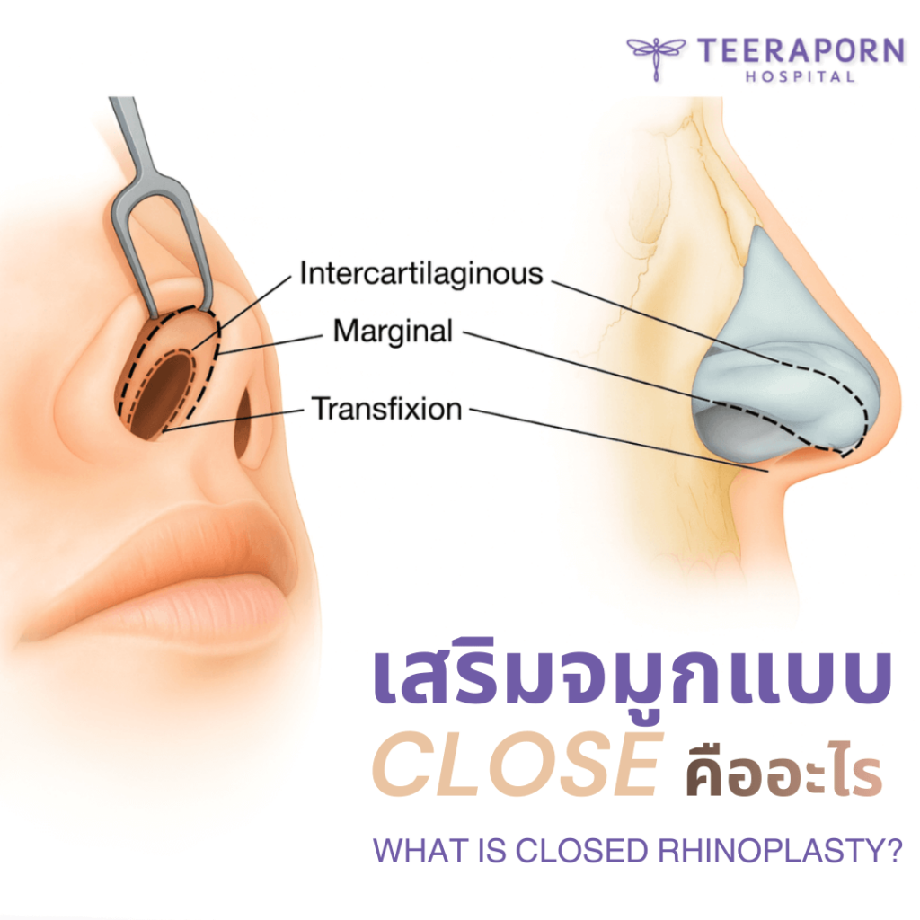 เสริมจมูกแบบ close