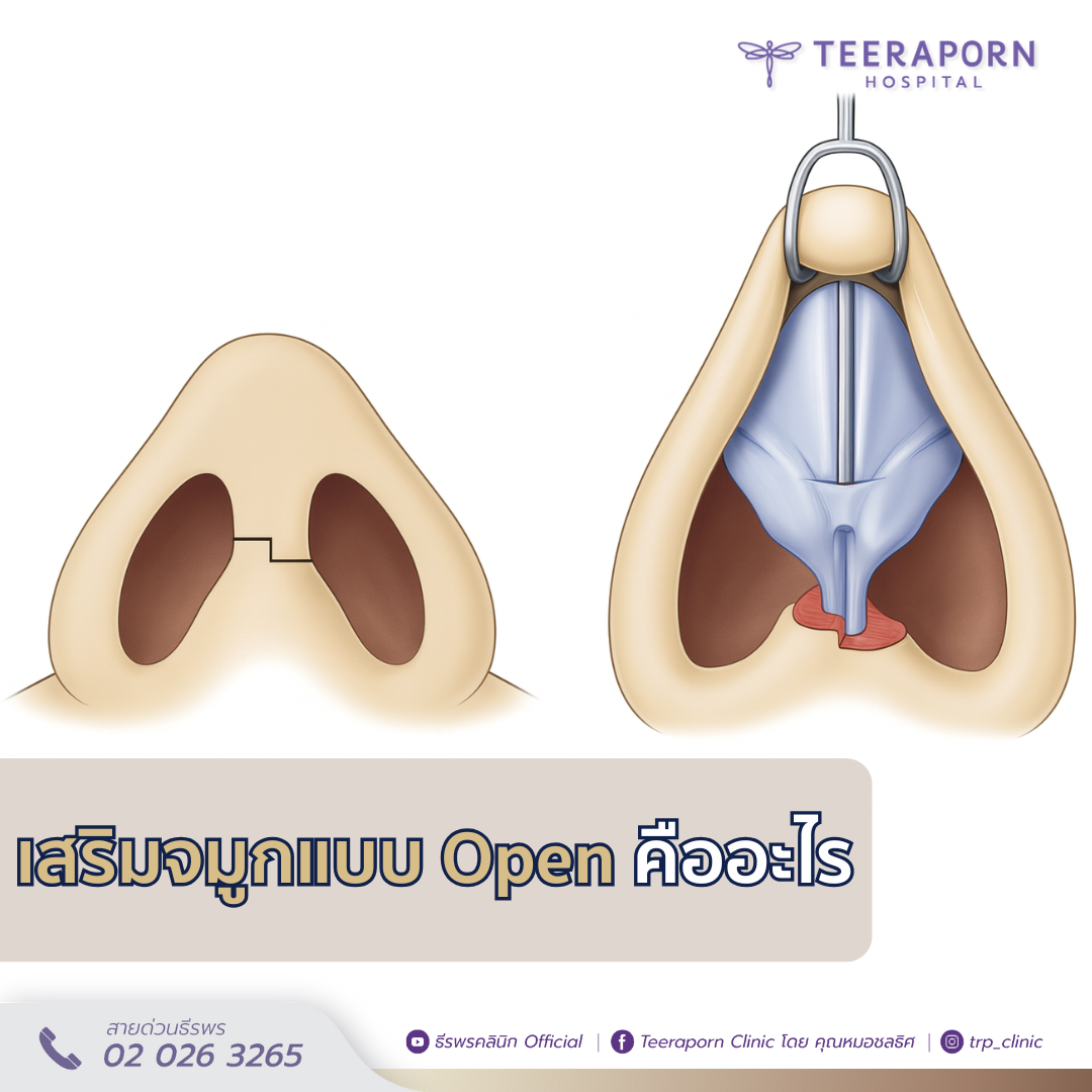 เสริมจมูกแบบโอเพ่น