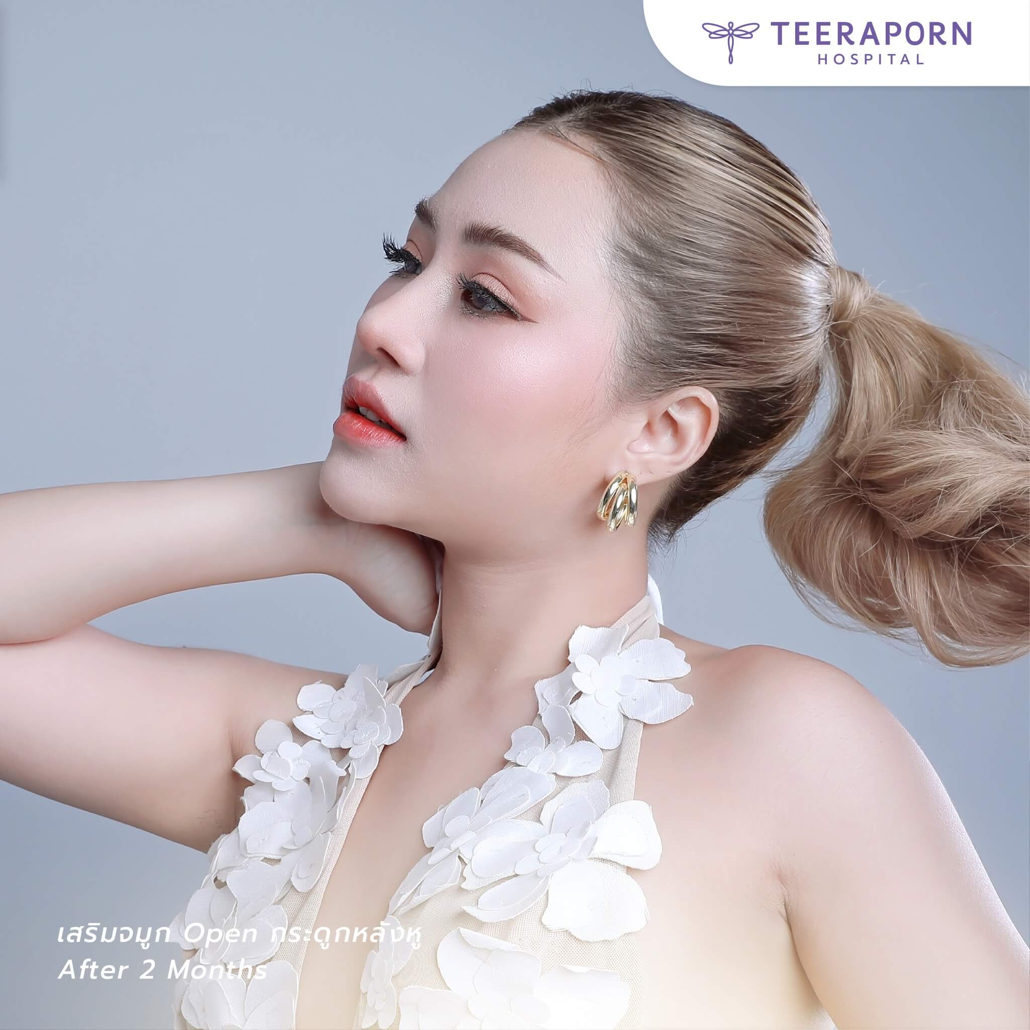 รีวิวเสริมจมูกแบบโอเพ่น