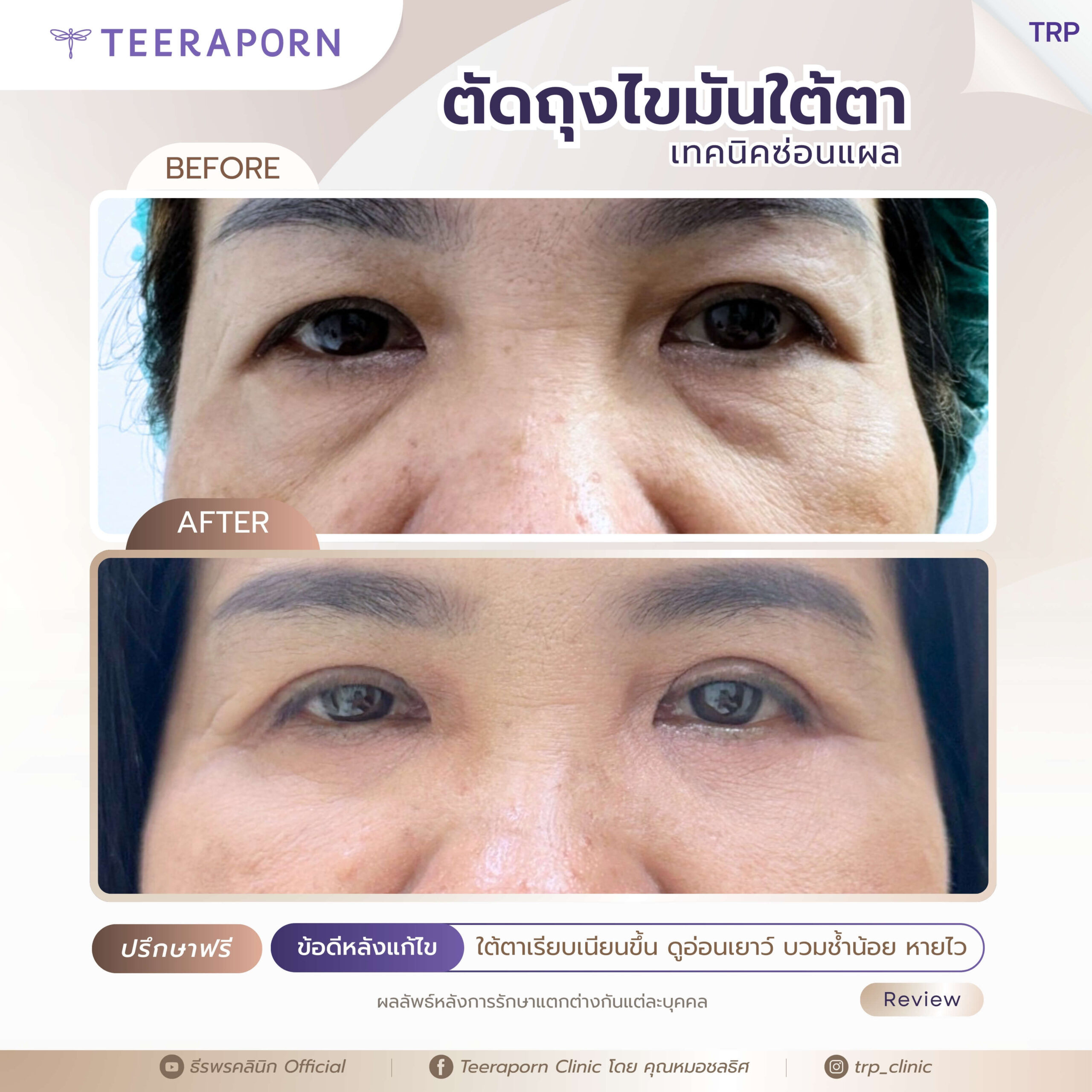 รีวิวตัดถุงใต้ตา 1