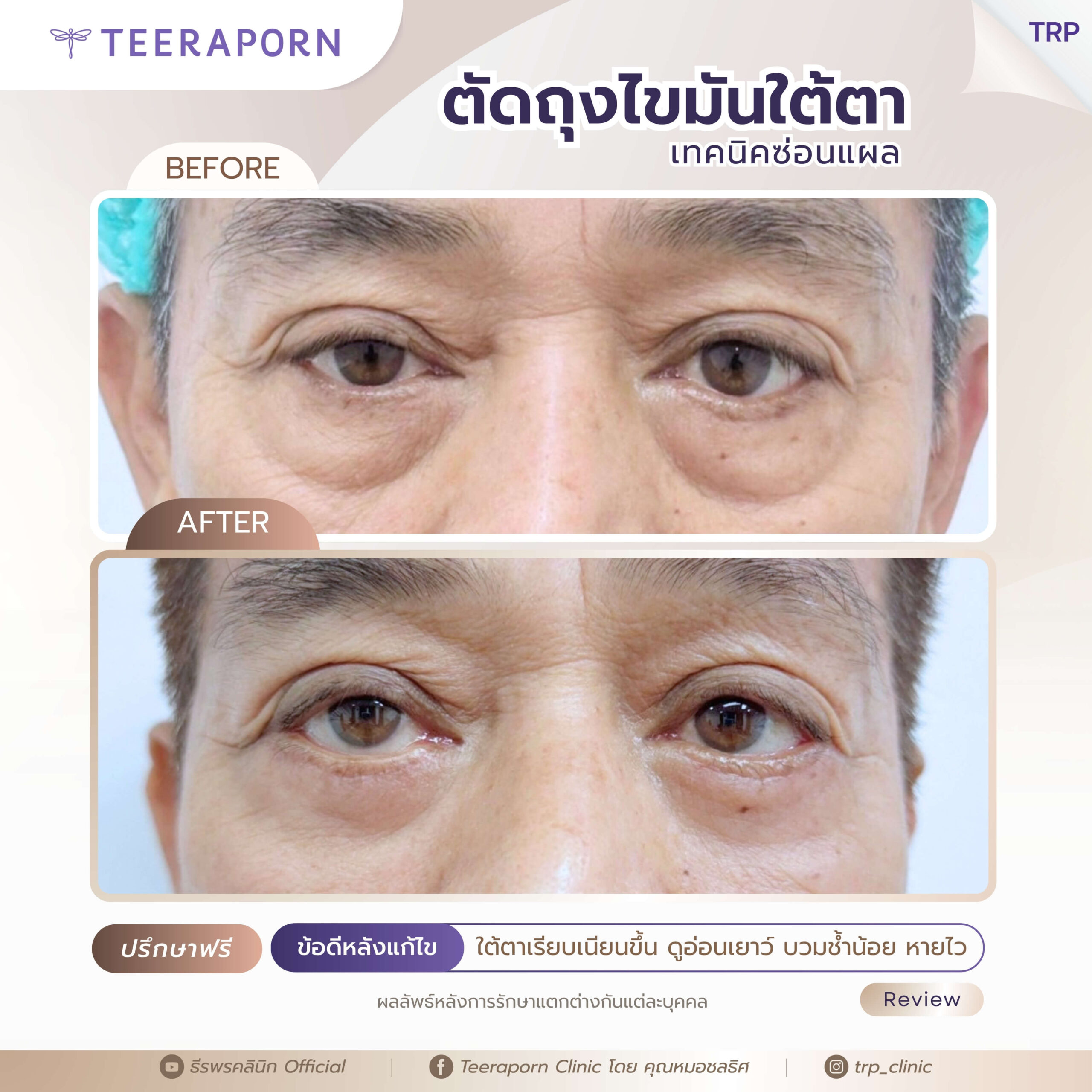 รีวิวตัดถุงใต้ตา 2