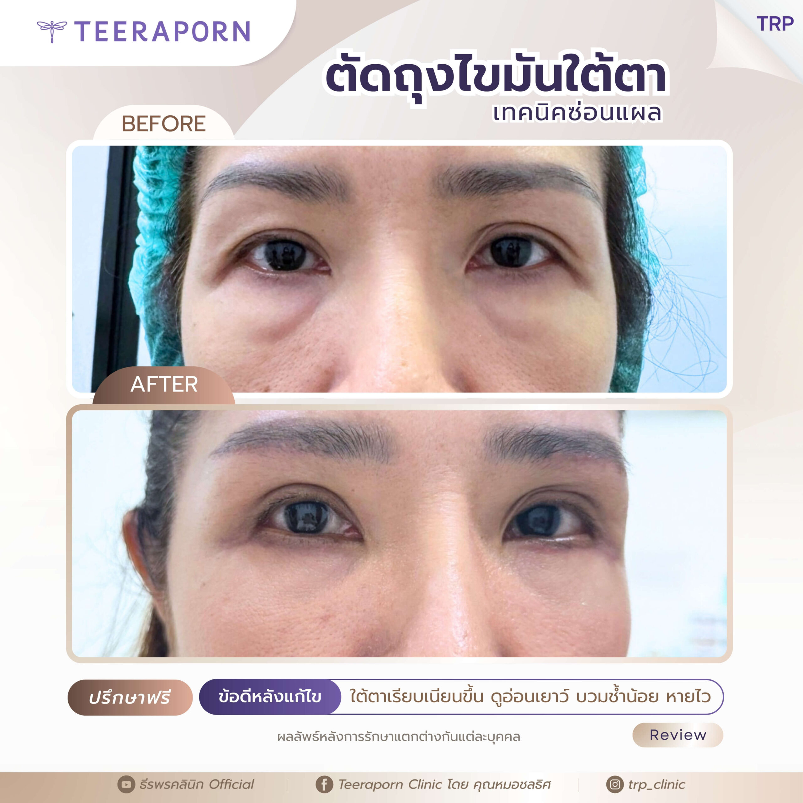 รีวิวตัดถุงใต้ตา 3