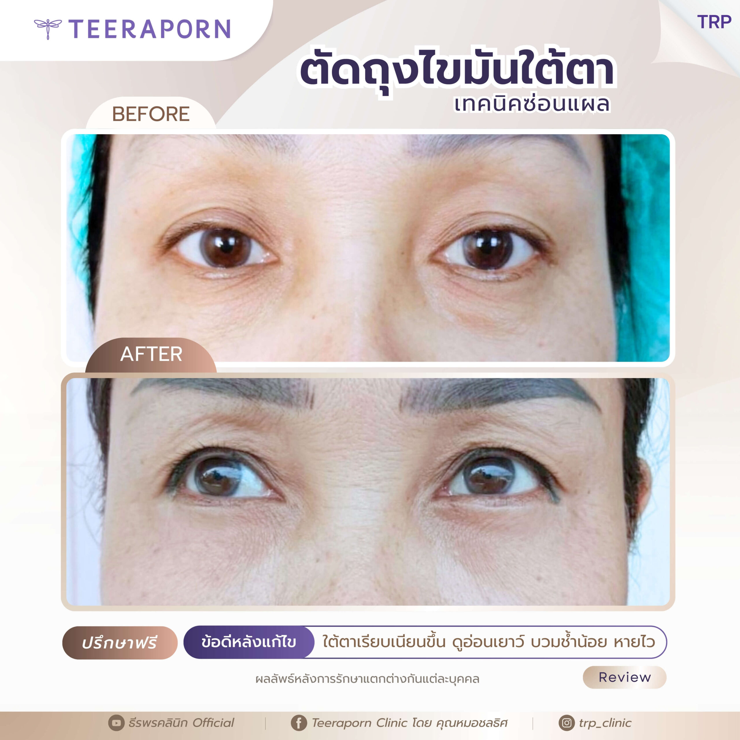รีวิวตัดถุงใต้ตา 4