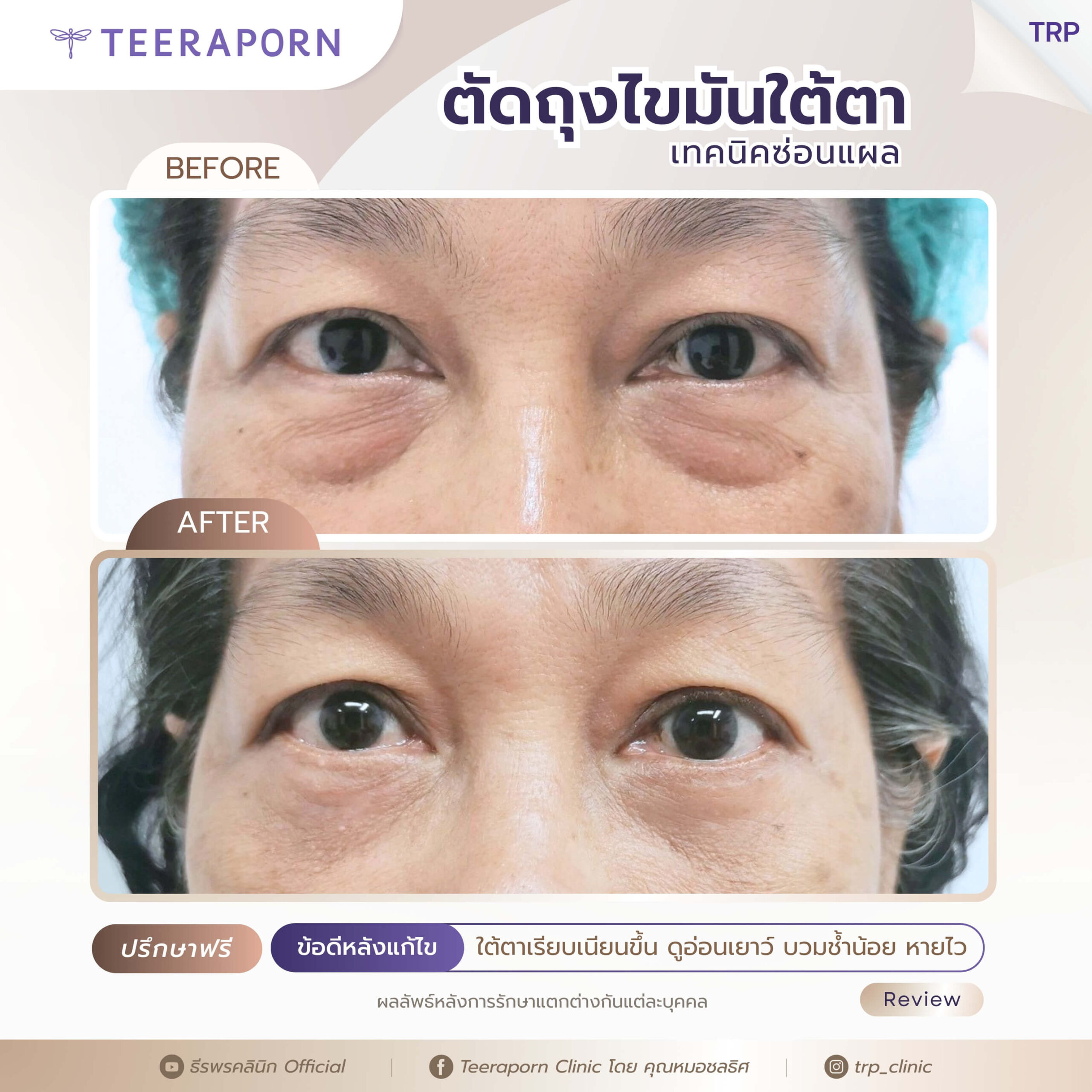 รีวิวตัดถุงใต้ตา 5
