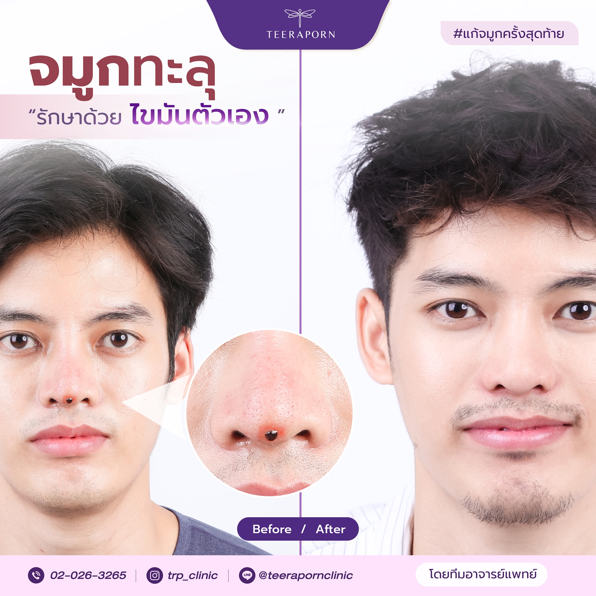 จมูกทะลุ วิธี แก้