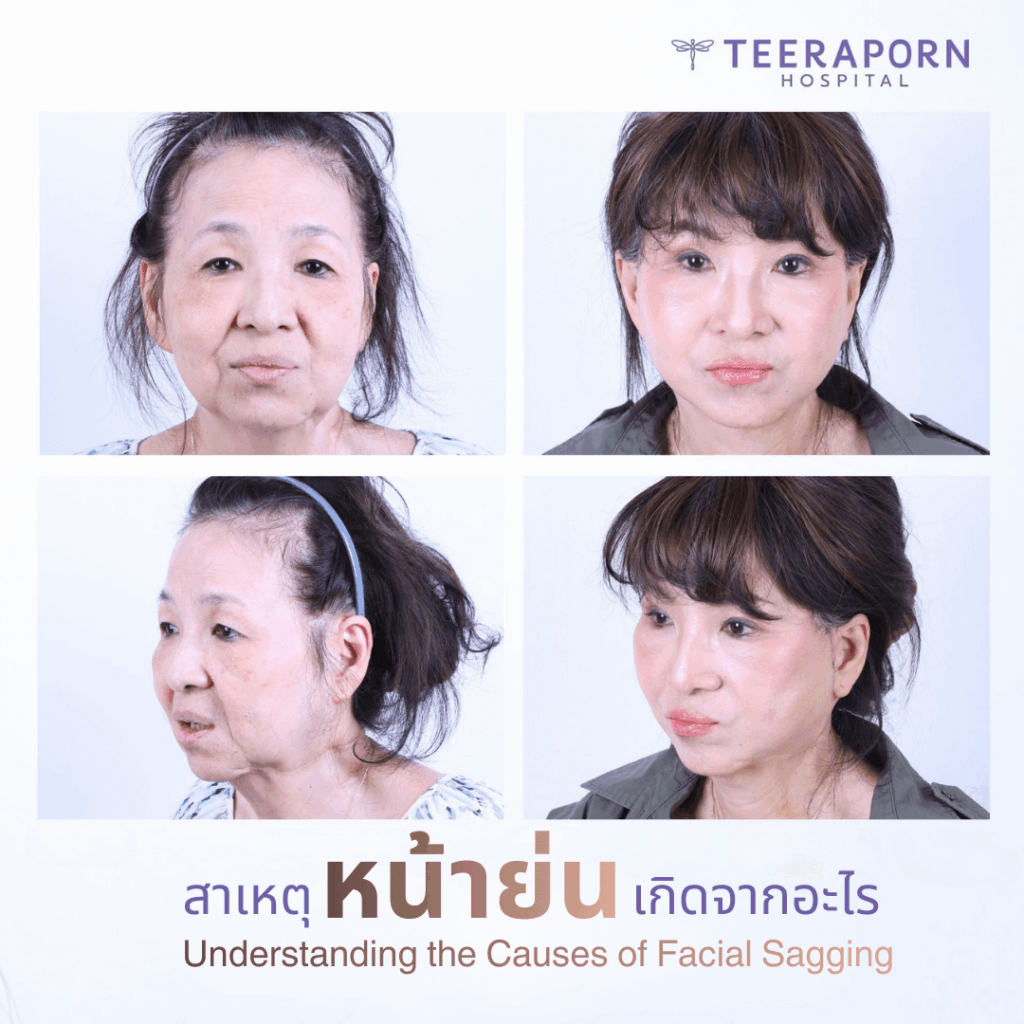 หน้าย่น