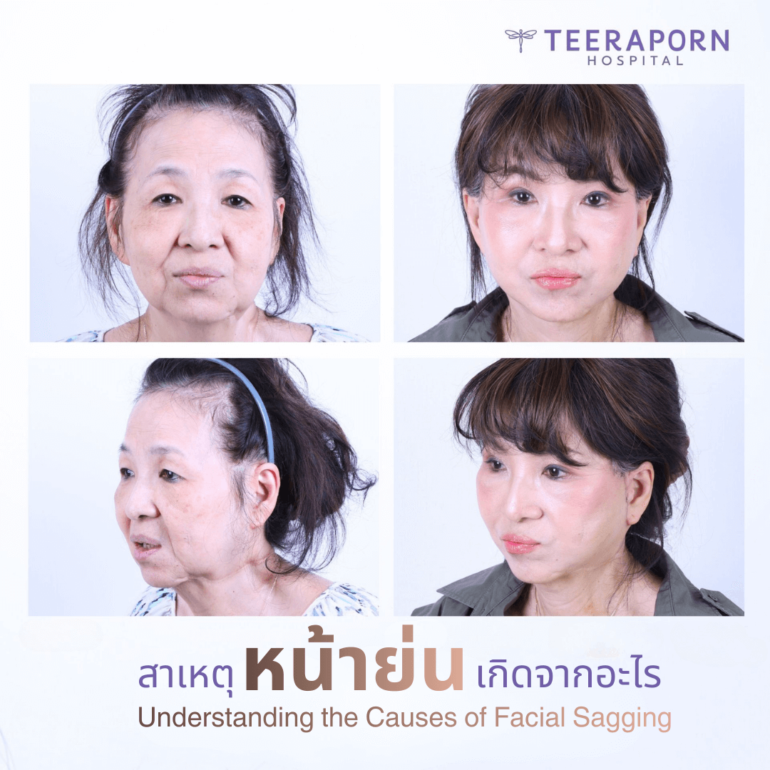 หน้าย่น