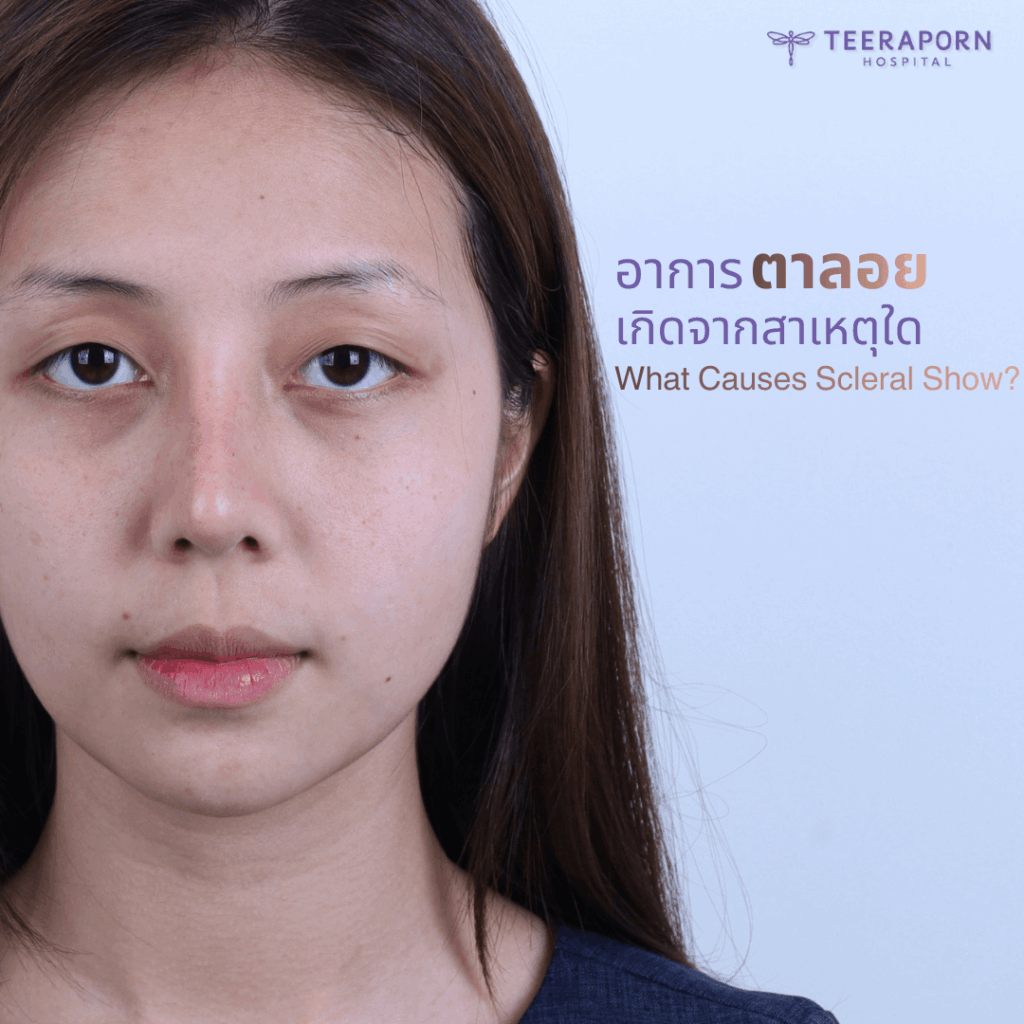 What Causes Scleral Show?