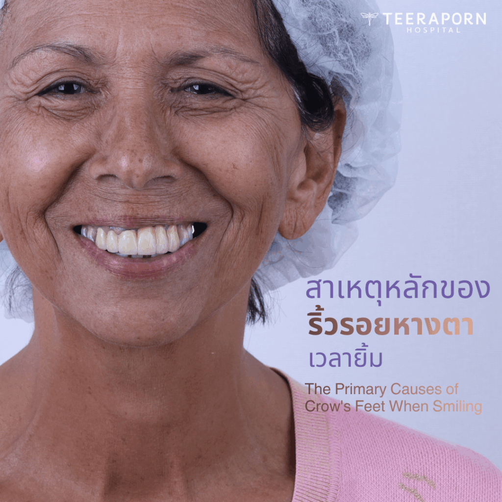 ริ้วรอย หางตา เวลายิ้ม