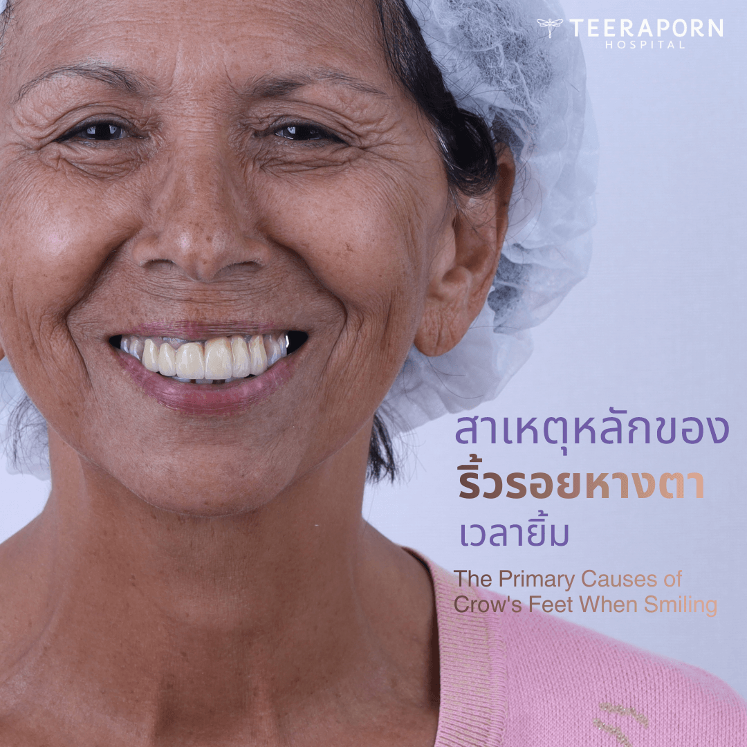 ริ้วรอย หางตา เวลายิ้ม