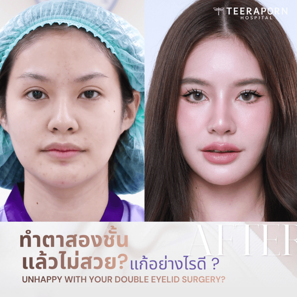 ทำตาสองชั้น แล้วไม่สวย