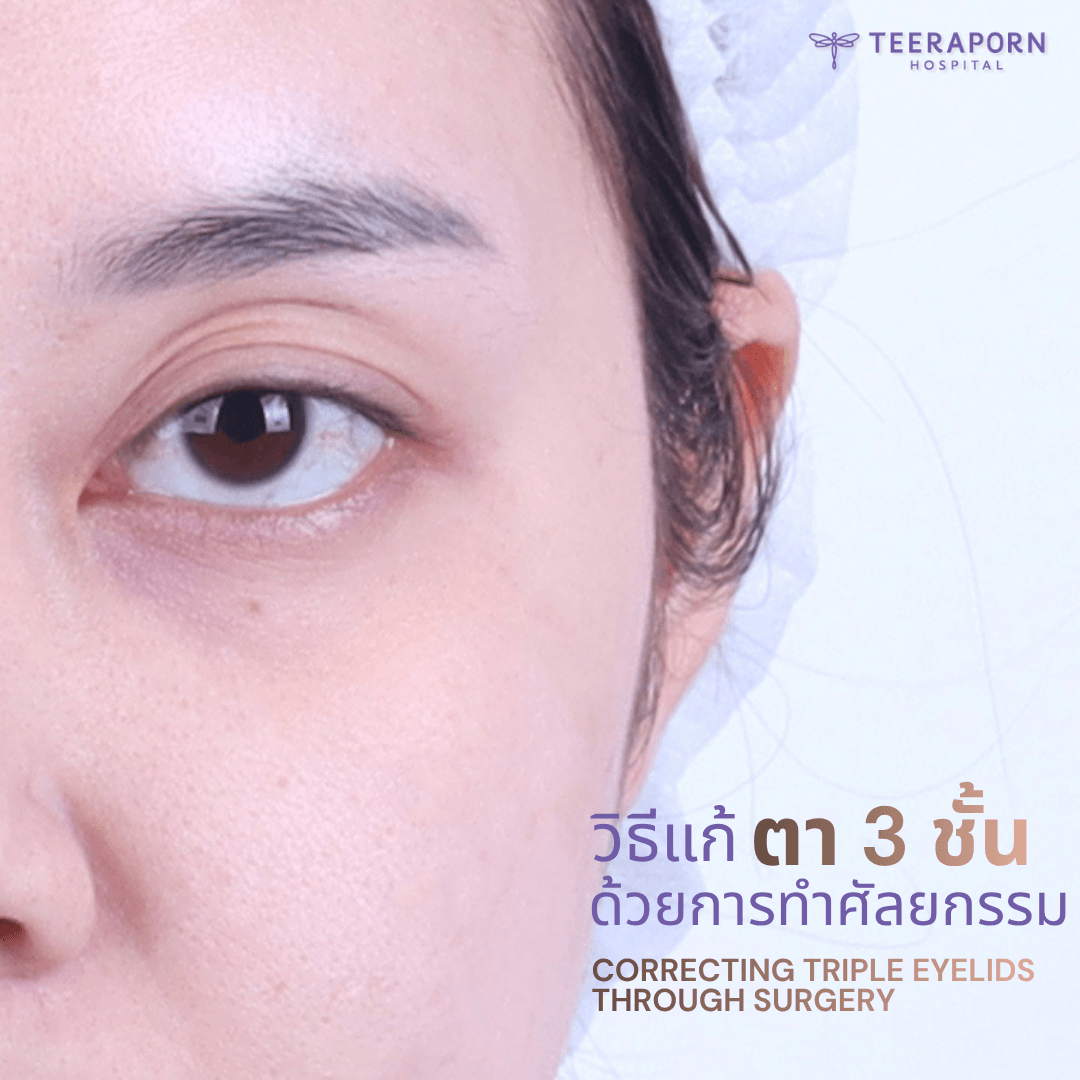 วิธีแก้ตา3ชั้น