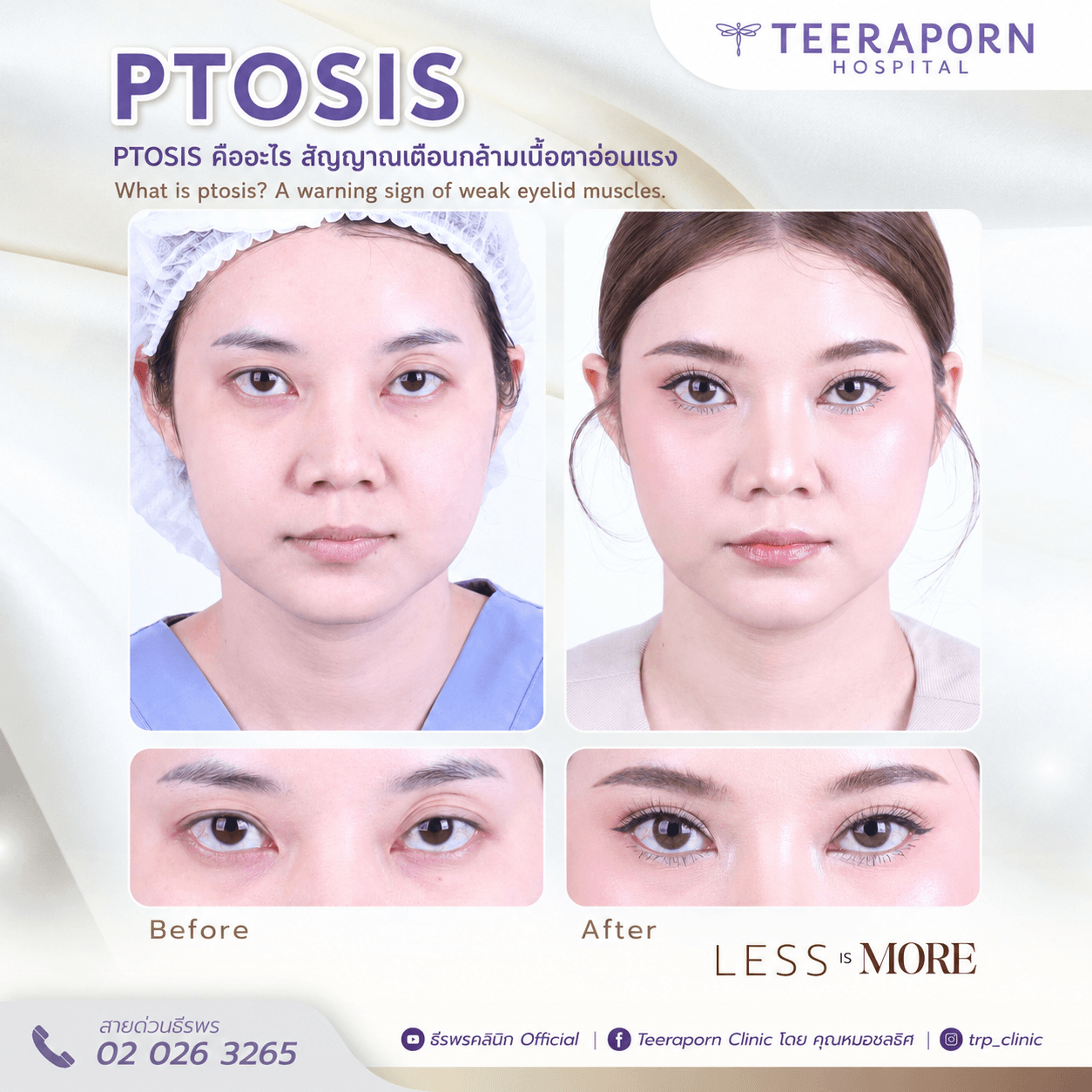 Ptosis คือ