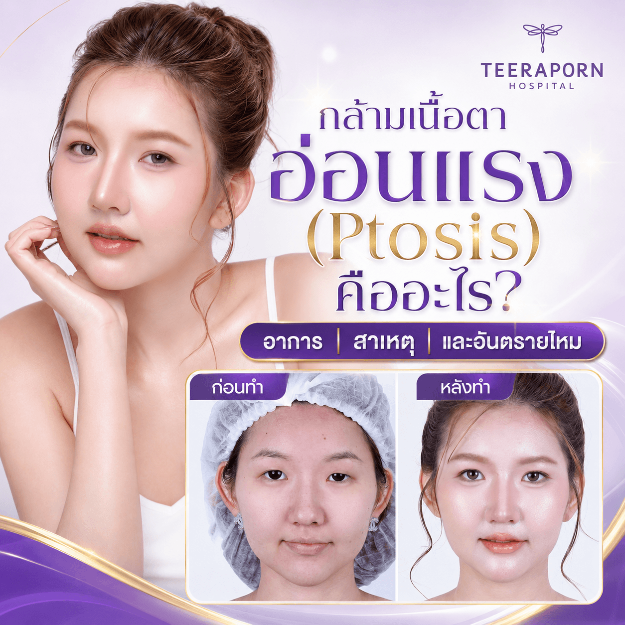 ptosis คืออะไร