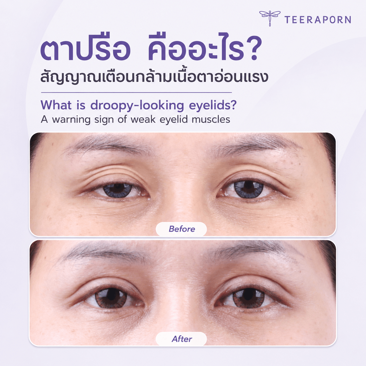 Ptosis (Sleepy Eyes)
