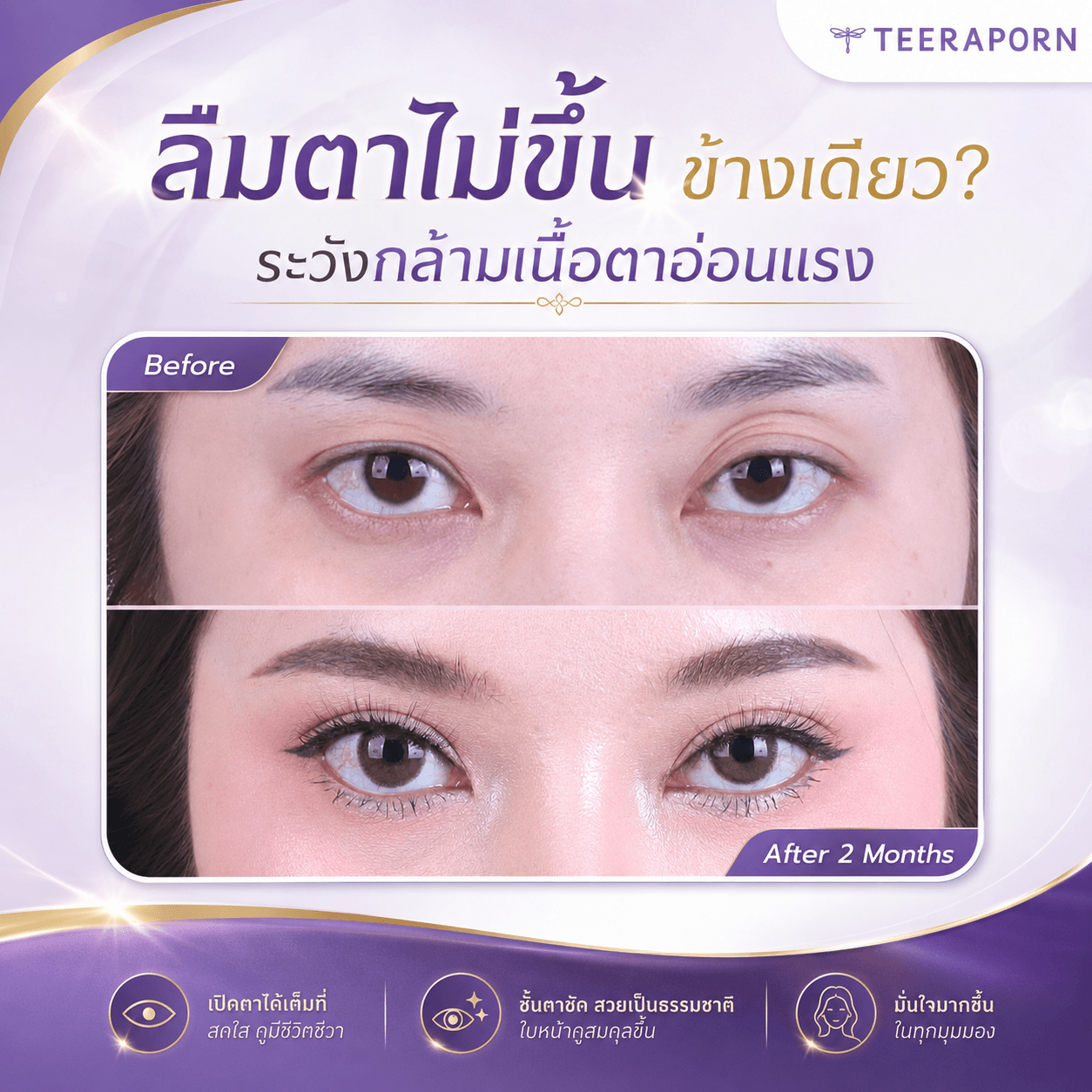 ลืมตาไม่ขึ้น ข้างเดียว