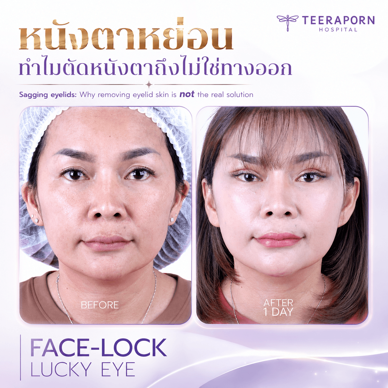 หนังตาหย่อน