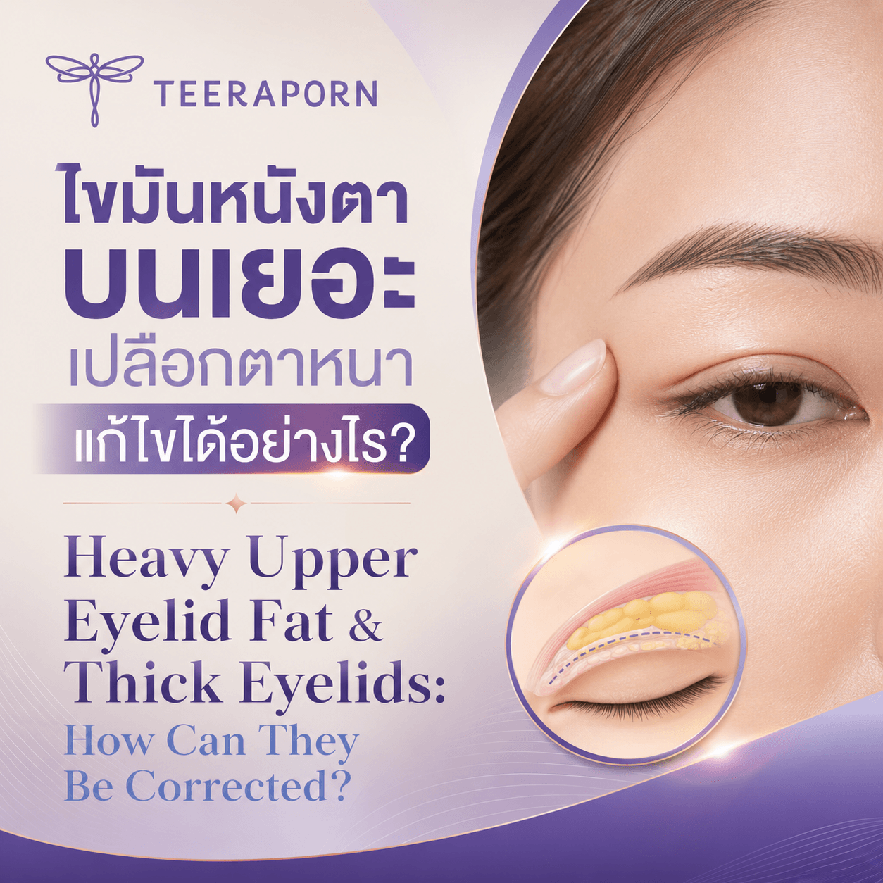ไขมันหนังตาบนเยอะ