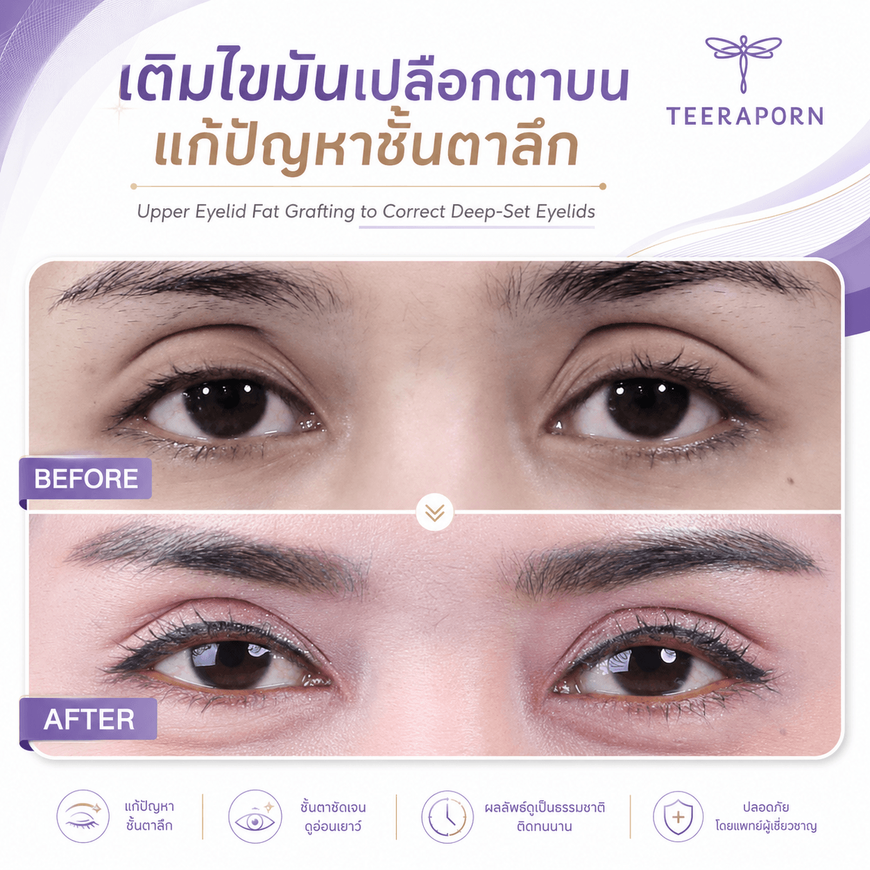 ไขมันเปลือกตาบน ราคา