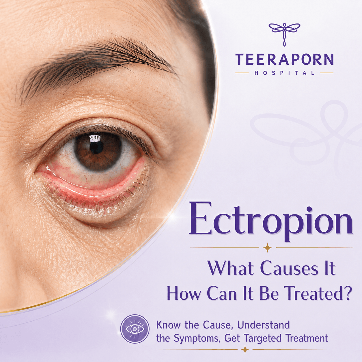Ectropion (Eyelid Eversion)