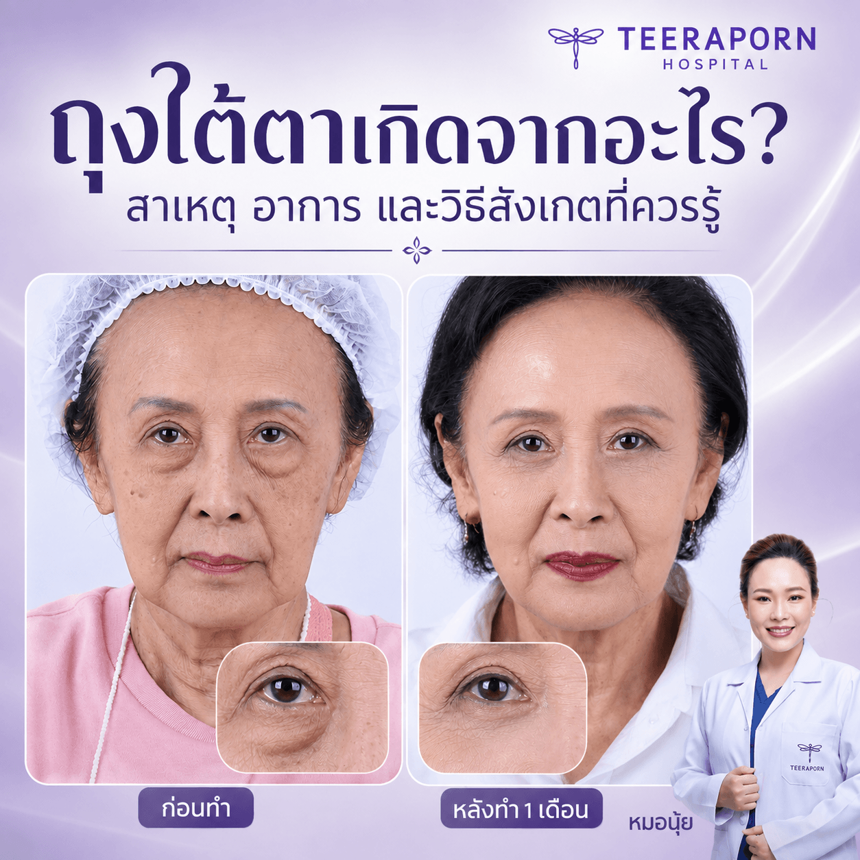ถุงใต้ตาเกิดจากอะไร