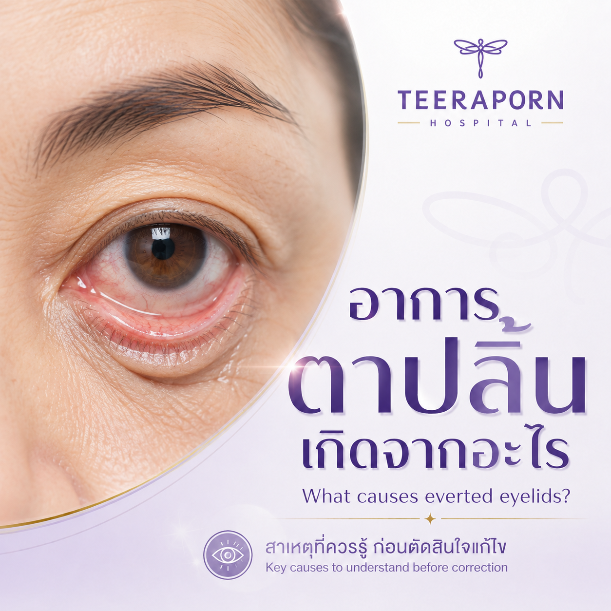 Ectropion (Eyelid Eversion)