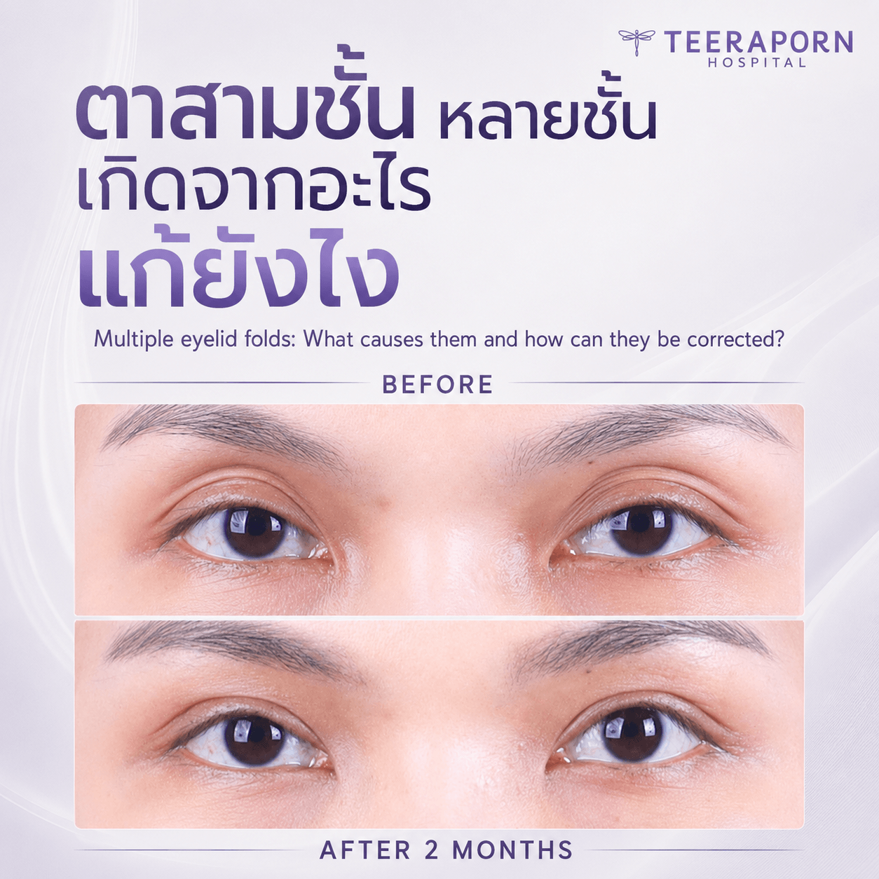 Triple Eyelids