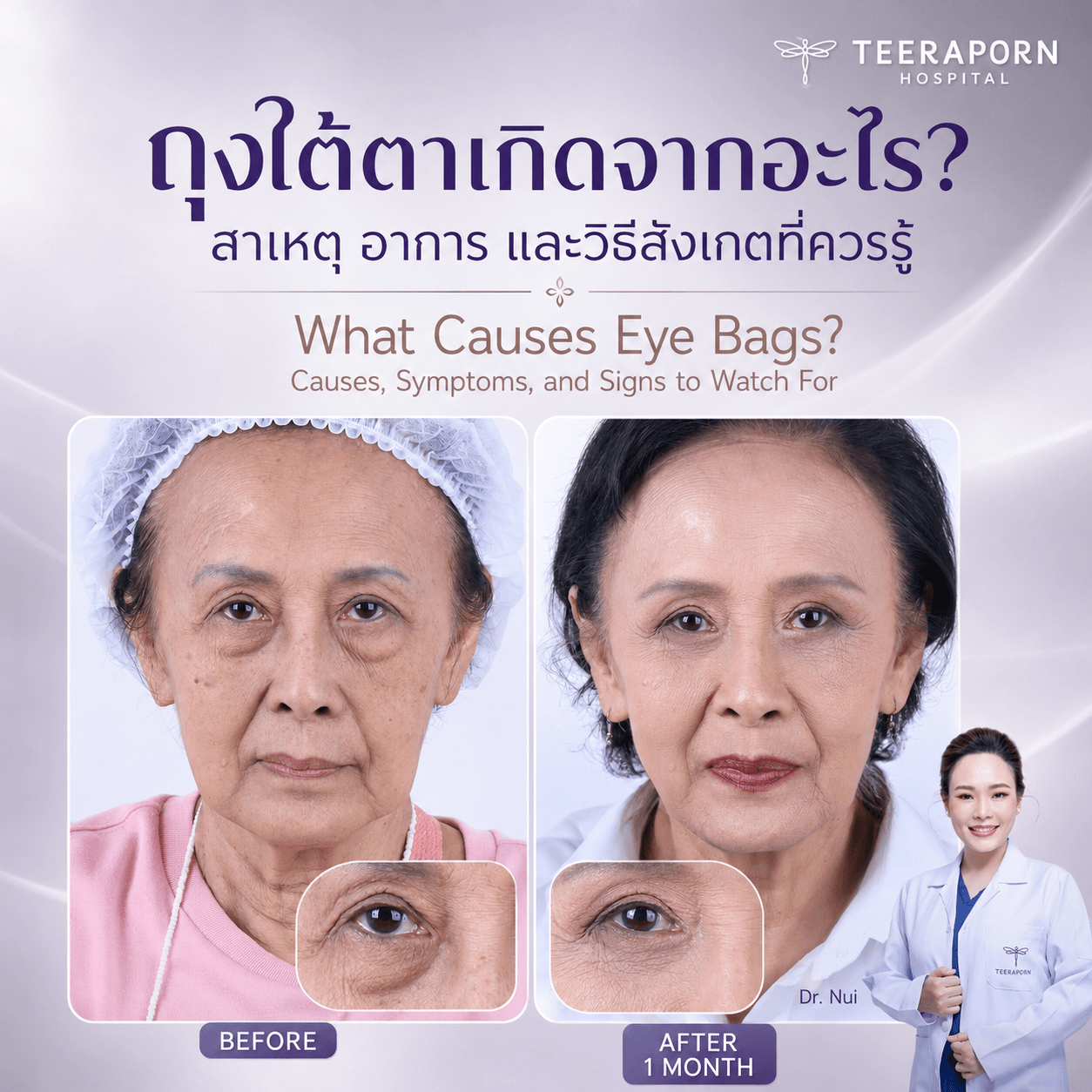 what causes under-eye bags.