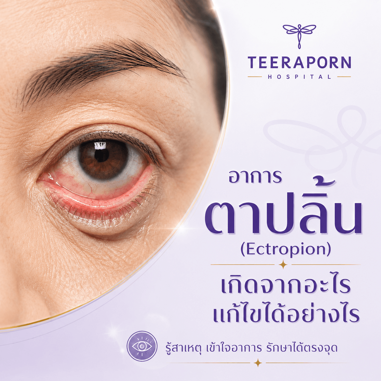 ตาปลิ้น