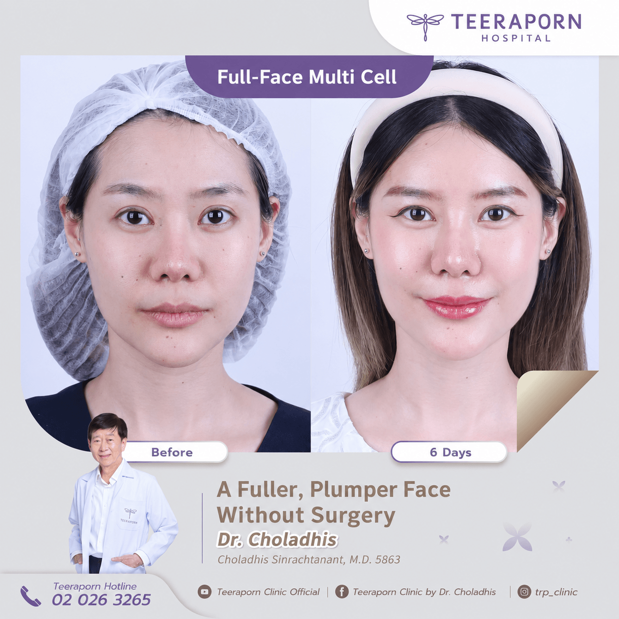 Facial Fat Grafting